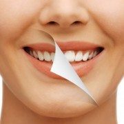 blanqueamiento dental