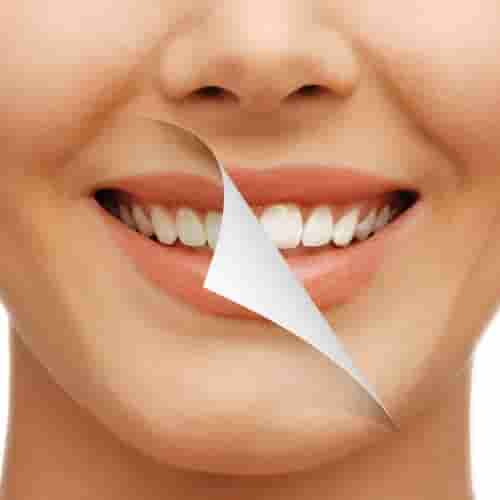 blanqueamiento dental