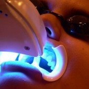 Blanqueamiento Dental en clínica