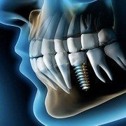 implante dental en mostoles